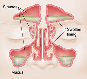 SNFORM - SINUS HERBAL FORMULA - Image 2