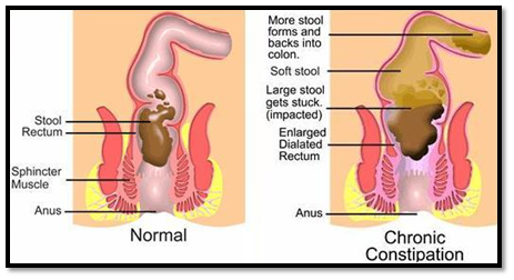 CSTFORM - CONSTIPATION HERBAL - Image 3