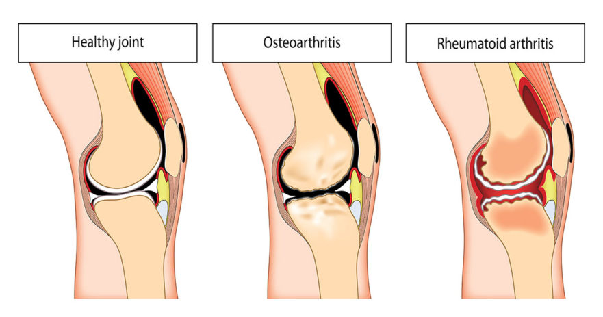 ARFORM - ARTHRITIS HERBAL - Image 2